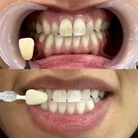 تخفیف ویژه جرمگیری و بلیچینگ (سفید کردن دندان)|خدمات آرایشگری و زیبایی|تهران, امیریه|دیوار