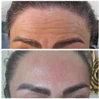 افر ویژه‌ی فیلر/بوتاکس/prpبا قیمت باورنکردنی|خدمات آرایشگری و زیبایی|تهران, دروازه شمیران|دیوار