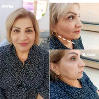 بلفاروپلاستی ،نخ سوپر لیفت تمامی خدمات بیوتی|خدمات آرایشگری و زیبایی|اصفهان, شهشهان|دیوار