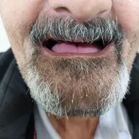 دندانسازی، دندان سازی، دندان مصنوعی، تعمیر شکستگی|خدمات آرایشگری و زیبایی|مشهد, یوسفیه|دیوار