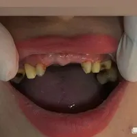 آفرعیدانه‌‌‌طرح‌لبخندکامپوزیت‌ولمینت‌دندان|خدمات آرایشگری و زیبایی|تهران, شهید رجایی|دیوار