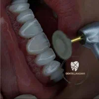 آموزش دندانپزشکی و کامپوزیت . لمینت .ترمیم|خدمات آموزشی|اسلام‌شهر, |دیوار
