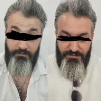 پنجاه درصد تخفیف بوتاکس|خدمات آرایشگری و زیبایی|اهواز, پادادشهر|دیوار