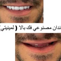 دندان مصنوعی/ دست دندان/ ژله ای/ چکی|خدمات آرایشگری و زیبایی|کرج, چهارصد دستگاه|دیوار
