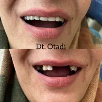 ساخت دست دندان مصنوعی طرح لمینیت و لبخند باضمانت|خدمات آرایشگری و زیبایی|تهران, طیب|دیوار