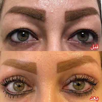 عمل بلفاروپلاستی درمان افتادگی پلک توسط متخصص چشم|خدمات آرایشگری و زیبایی|یاسوج, |دیوار