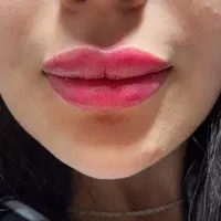 بوتاکس، فیلر،ژل لب، زاویه سازی مزوتراپی توسط پزشک