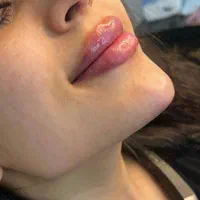 ژل لب هایفولیفت نخ زاویه چانه بوتاکس فیلربینی لیزر|خدمات آرایشگری و زیبایی|مشهد, فرهنگ|دیوار