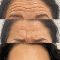 بوتاکس تخصصی با روش انحصاری DAN|خدمات آرایشگری و زیبایی|ابهر, |دیوار