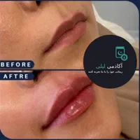 بوتاکس ژل لب زاویه فک.گونه .چانه. پرکردن صورت لاغر|خدمات آرایشگری و زیبایی|قم, زنبیل آباد|دیوار