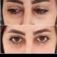 بوتاکس مصپورت فقط ۴۹۰ وفیلر ۵۹۰ پی ارپی ۸۵۰|خدمات آرایشگری و زیبایی|اصفهان, رزمندگان|دیوار