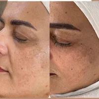میکرونیدلینگ کربوکسی تراپی co2 (سفید کننده پوست )|خدمات آرایشگری و زیبایی|یزد, |دیوار