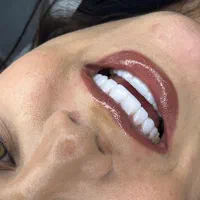 کامپوزیت دندان /لمینت / عصب کشی / زیبایی|خدمات آرایشگری و زیبایی|تهران, تهرانپارس غربی|دیوار