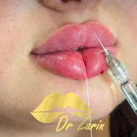دکتر زرین لیپ ، فیلر لب روسی زاویه فک گونه چانه ژل|خدمات آرایشگری و زیبایی|تهران, پونک|دیوار
