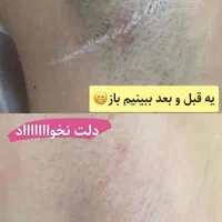 لیزر موهای زائد لیزر آقایان لیزر بانوان لیزر خانم|خدمات آرایشگری و زیبایی|اصفهان, سعادت‌آباد|دیوار