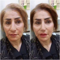 بلفاروپلاستی ،نخ سوپر لیفت تمامی خدمات بیوتی|خدمات آرایشگری و زیبایی|اصفهان, شهشهان|دیوار