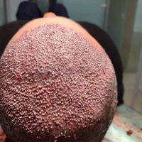 جذب تکنسین کاشت مو