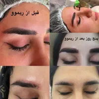 مرکز فیبروز و ریموو تک جلسه ای