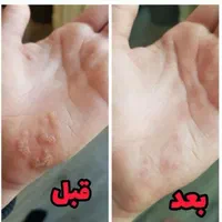 برطرف کردن زگیل و تبخال|خدمات آرایشگری و زیبایی|اهواز, کوروش|دیوار