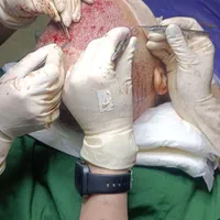 کاشت مو ابرو درمرکزجراحی بیمارستانی نه کلینیک ومطب|خدمات آرایشگری و زیبایی|تهران, فردوسی|دیوار