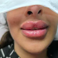 تزریق تخصصی ژل و بوتاکس صورت