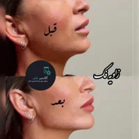بوتاکس ژل لب زاویه فک.گونه .چانه. پرکردن صورت لاغر|خدمات آرایشگری و زیبایی|قم, زنبیل آباد|دیوار