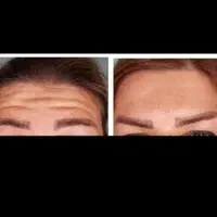 بوتاکس صورت و زیر بغل(جشنواره)در مطب|خدمات آرایشگری و زیبایی|اصفهان, ملک‌شهر|دیوار