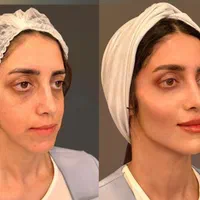 اصلاح فرم صورت.جوانسازی به روش یانگ فیس توسط متخصص|خدمات آرایشگری و زیبایی|مشهد, سناباد|دیوار