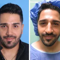 10 میلیون تخفیف عمل جراحی بینی بدون تامپون،لیفت|خدمات آرایشگری و زیبایی|فردیس, طالقانی|دیوار