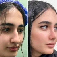 عمل بینی/پیکرتراشی /فقط با 20 /اقساطی ماهی پنج|خدمات آرایشگری و زیبایی|شیراز, زرگری|دیوار
