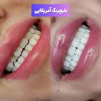 کامپوزیت،لمینیت،روکش،بلیچینگ در دندانپزشکی کیانمهر|خدمات آرایشگری و زیبایی|کرج, کیانمهر|دیوار