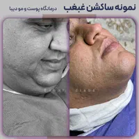 رفع و ساکشن غبغب 100% تضمین کتبی|خدمات آرایشگری و زیبایی|تهران, صادقیه|دیوار