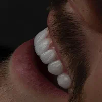 ایمپلنت دندان دندانپزشکی کامپوزیت لمینت کلیه خدمات|خدمات آرایشگری و زیبایی|شهرکرد, |دیوار