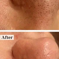 پاکسازی و فشیال پوست، اسکالپ کف سر، آموزش صفرتاصد|خدمات آرایشگری و زیبایی|قزوین, |دیوار