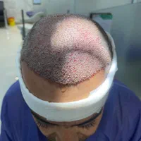 کاشت مو،کاشت ابرو و ریش تخصصی|خدمات آرایشگری و زیبایی|شیراز, قصرالدشت|دیوار