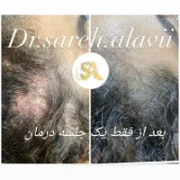 درمان ریزش مو توسط پزشک