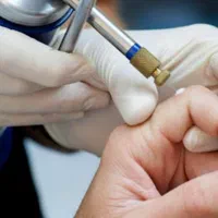 درمان زگیل تناسلی/لیزر/کرایو فریز/hpv/توسط پزشک|خدمات آرایشگری و زیبایی|اهواز, کیانپارس |دیوار