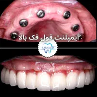 دندانپزشکی تخصصی ایمپلنت پیوند استخوان /اقساط|خدمات آرایشگری و زیبایی|تهران, پونک|دیوار