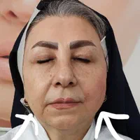 لیفت با نخ و جوانسازی با نخ با قیمت عالی توسط پزشک|خدمات آرایشگری و زیبایی|اسلام‌شهر, باغ فیض|دیوار