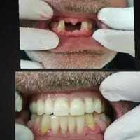دندانسازی،دندان مصنوعی،جوان پسند،اقساطی با چک|خدمات آرایشگری و زیبایی|مشهد, شاهد (شهرک غرب)|دیوار