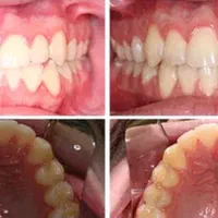 ارتودنسی ثابت ومتحرک|خدمات آرایشگری و زیبایی|شیراز, قصرالدشت|دیوار