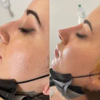 آنزیم ترکیبی بینی گوشتی،لیفت بینی،ژل لب،مزوتراپی|خدمات آرایشگری و زیبایی|تهران, سعادت‌آباد|دیوار