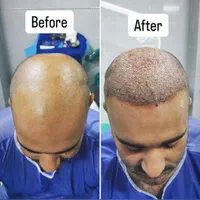 کاشت مو و ابرو و انجام بوتاکس و مزوتراپی و PRP|خدمات آرایشگری و زیبایی|قزوین, |دیوار