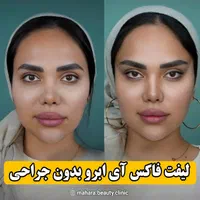 یانگ فیس صورت Noa بینی ابرو غبغب سینه باسن شکم پلک|خدمات آرایشگری و زیبایی|مشهد, هفت تیر (حافظ)|دیوار