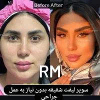 هایفو صورت،واژن.لیفت ابرو.لاغری ژل آنزیم مزو|خدمات آرایشگری و زیبایی|مشهد, آزادشهر|دیوار