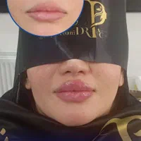 تزریق ژل وبوتاکس و لیزر موی زایدولیزر پاک کردن تتو