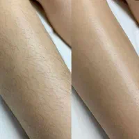 اپیلاسیون تخصصی حلما