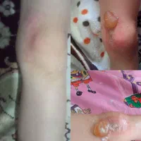 کلینیک تخصصی درمان انواع زخم(بستر و دیابت) فردوس|خدمات آرایشگری و زیبایی|اصفهان, محله سفلی|دیوار