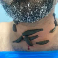 آموزش وانجام تخصصی حجامت زالو،سیاتیک ونازایی میگرن|خدمات آرایشگری و زیبایی|شیراز, قدوسی شرقی|دیوار