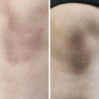 لیزر مو جشنواره. ژل بوتاکس حذف تتو و لک جوانسازی|خدمات آرایشگری و زیبایی|ساری, |دیوار